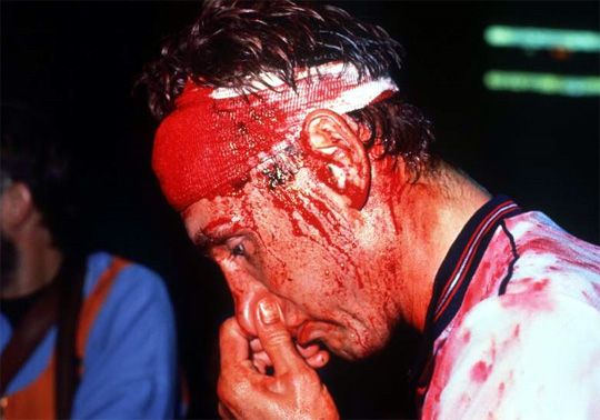 Terry Butcher ilyen állapotban játszotta végig a '87-es svéd–angol meccset (Fotó: Action Images)