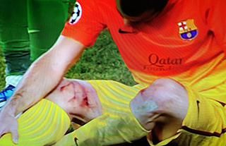 Mascherano vérző sérüléssel, hordágyon hagyta el a pályát
(Fotó: sport.es)